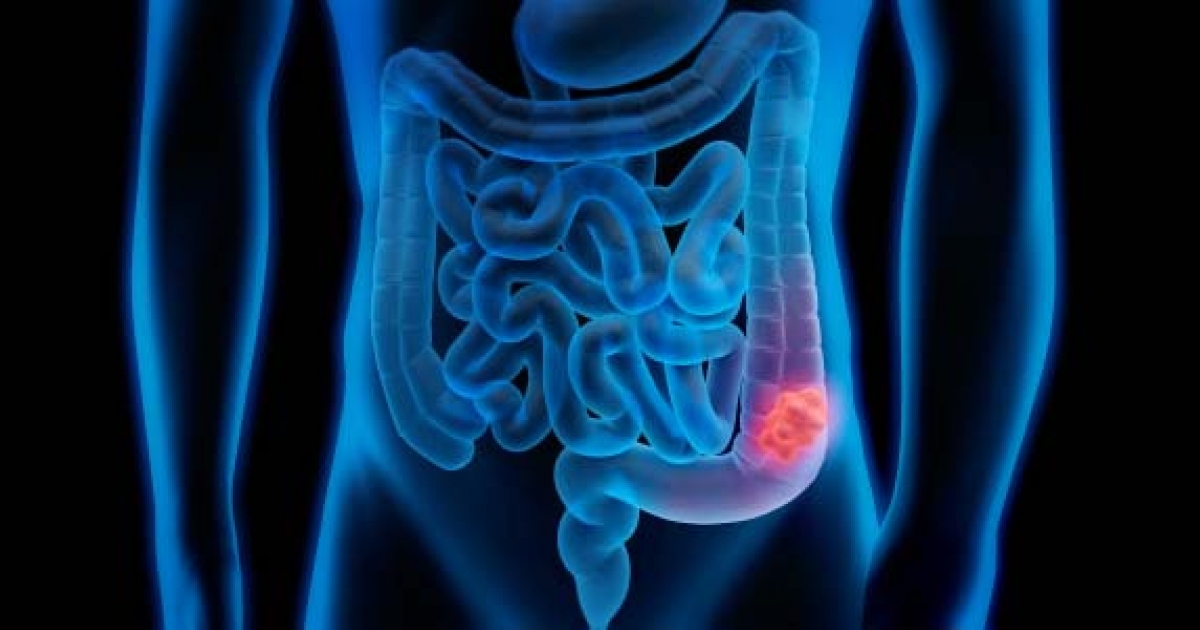 Nowotwór okrężnicy Zalecenia Krajowy Rejestr Nowotworów